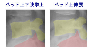 椎間孔比較