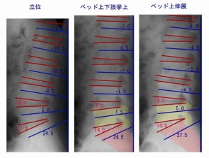 椎体角度比較新