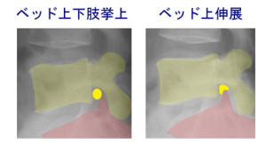 椎間孔比較_神経根