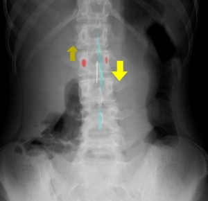 ローテーション腰椎