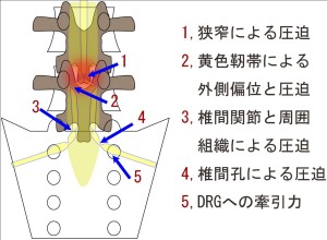 狭窄12