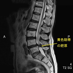 狭窄01