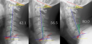頸椎前傾02