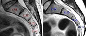 仙骨MRI