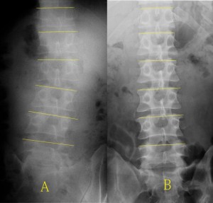 StandLumbar01