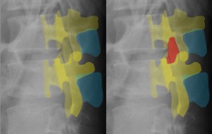 StandLumbar09